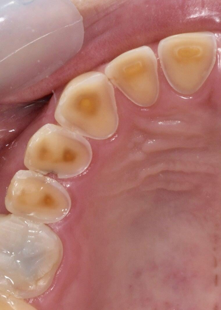 Home Remedies for Bruxism Ways to Prevent Attrition